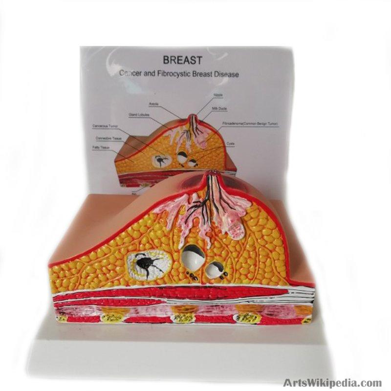 Breast Pathology Anatomy Model Kit, Breast Lesion Model