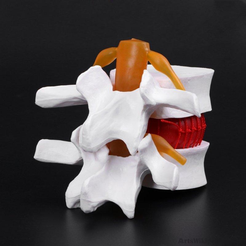 Human Anatomical Spine Lumbar Disc Herniation Model Anatomy Instrume ...