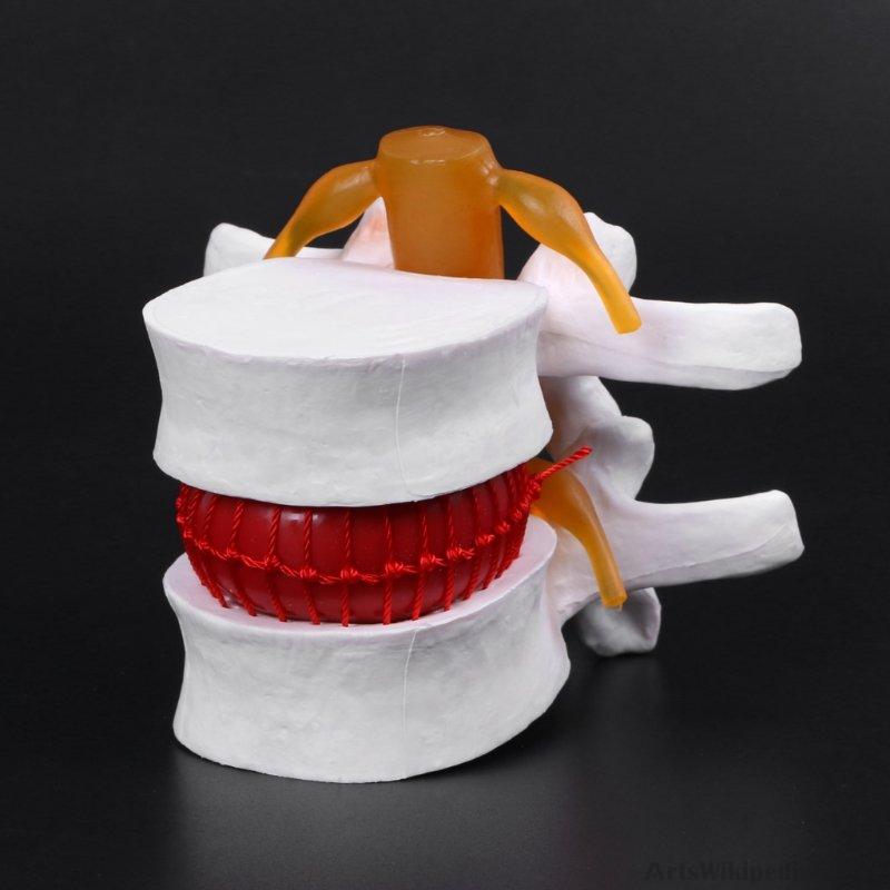 Human Anatomical Spine Lumbar Disc Herniation Model Anatomy Instrume ...